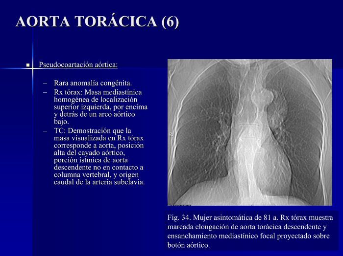 AORTA TORÁCICA (5) • D
