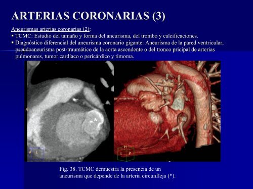 calcificaciones miocárdicas - 30 Congreso de la SERAM. A Coruña ...