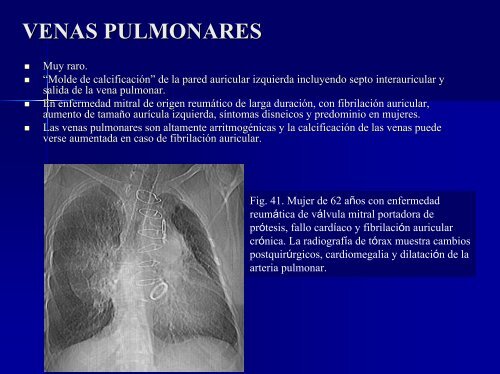 calcificaciones miocárdicas - 30 Congreso de la SERAM. A Coruña ...