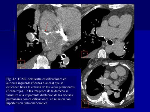 calcificaciones miocárdicas - 30 Congreso de la SERAM. A Coruña ...