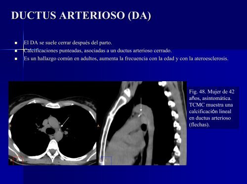 calcificaciones miocárdicas - 30 Congreso de la SERAM. A Coruña ...