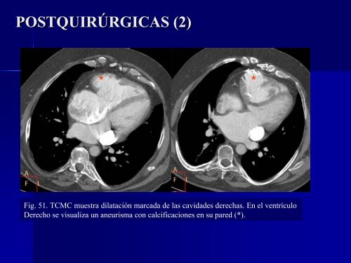 calcificaciones miocárdicas - 30 Congreso de la SERAM. A Coruña ...