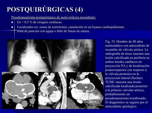 calcificaciones miocárdicas - 30 Congreso de la SERAM. A Coruña ...