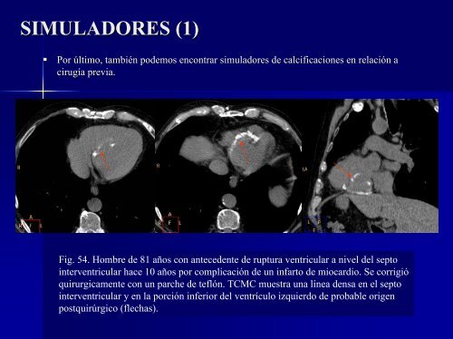 calcificaciones miocárdicas - 30 Congreso de la SERAM. A Coruña ...