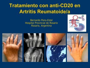 Tratamiento con anti-CD20 en Artritis Reumatoide/a