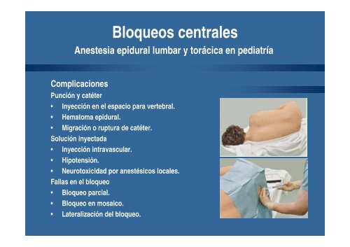 Bloqueos analgÃ©sicos en pediatrÃ­a