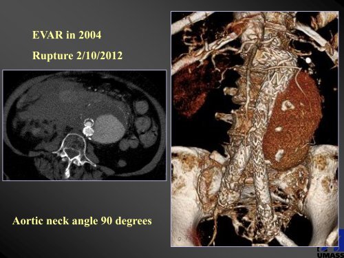 EVAR Instructions for Use (IFU): What They Mean ... - VascularWeb