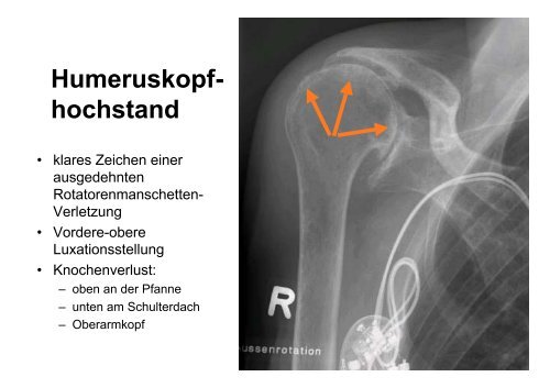 das PDF des Vortrags downloaden - OrthopÃ¤disches Fachzentrum ...