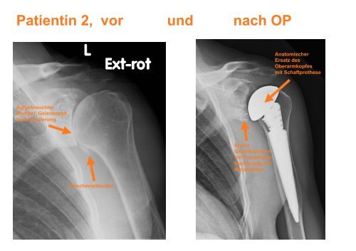 das PDF des Vortrags downloaden - OrthopÃ¤disches Fachzentrum ...