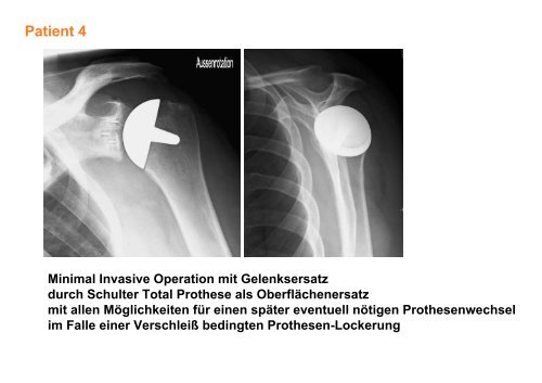 das PDF des Vortrags downloaden - OrthopÃ¤disches Fachzentrum ...