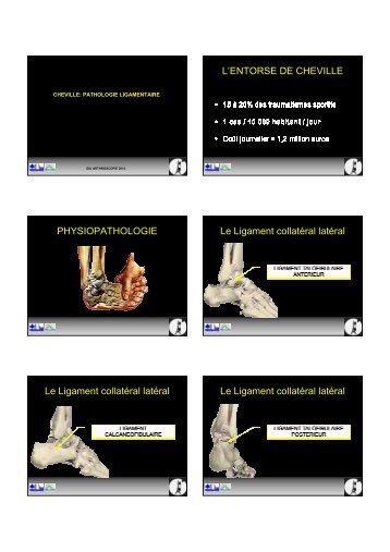 L'ENTORSE DE CHEVILLE PHYSIOPATHOLOGIE Le Ligament ...