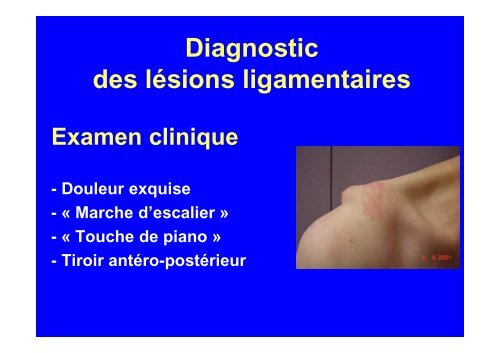 Les disjonctions acromio-claviculaires - Pr Saragaglia