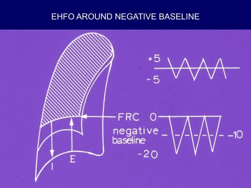 Biphasic Cuirass Ventilation