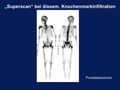 SD-Szintigraphie