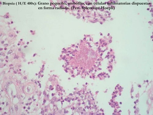 Actinomicetoma - PIEL-L Latinoamericana