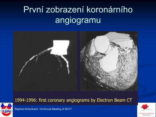 Mohou novÃ© neinvazivnÃ­ metody nahradit koronarografii