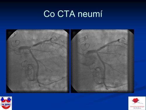 Mohou novÃ© neinvazivnÃ­ metody nahradit koronarografii