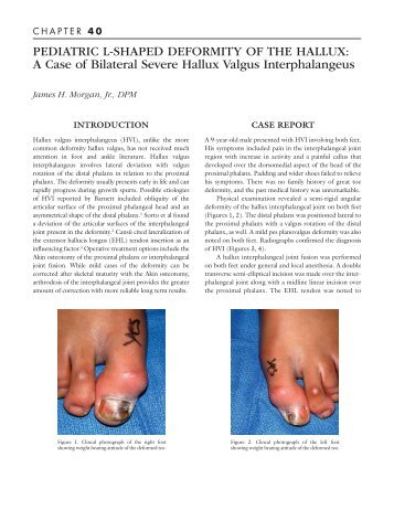 A Case of Bilateral Severe Hallux Valgus Interphalangeus