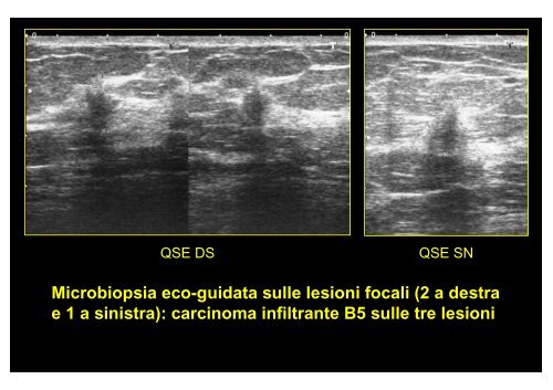 Microbiopsia stereo-guidata