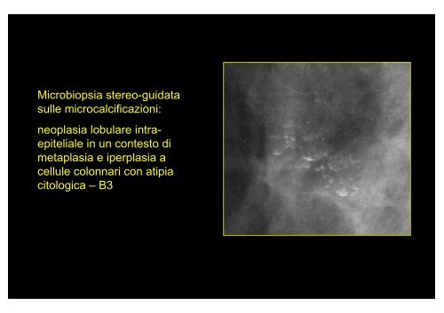 Microbiopsia stereo-guidata