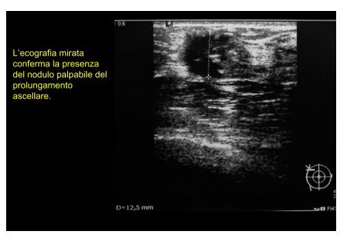 Microbiopsia stereo-guidata