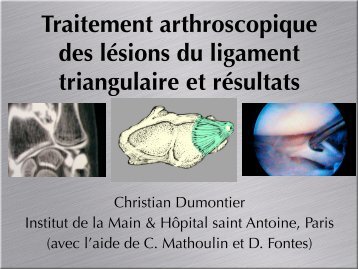 Ligament triangulaire traitement arthroscopie C ... - ClubOrtho.fr