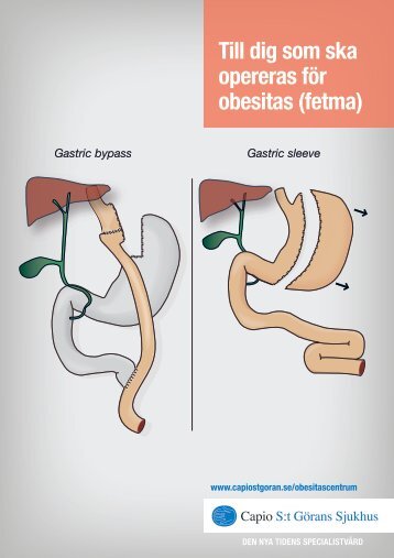 broschyr - Capio S:t GÃ¶rans Sjukhus
