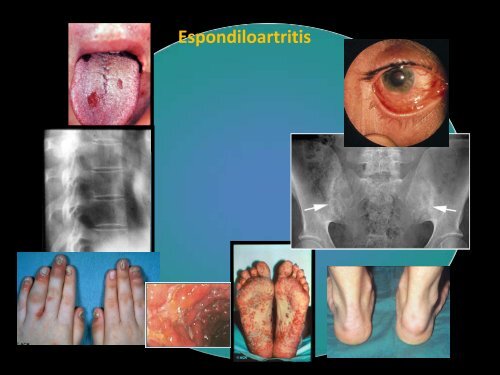 Concepto de enfermedad inflamatoria articular en el adulto