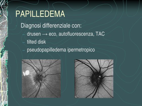 Cosa puÃ² nascondersi dietro un gonfiore papillare - R. Salati