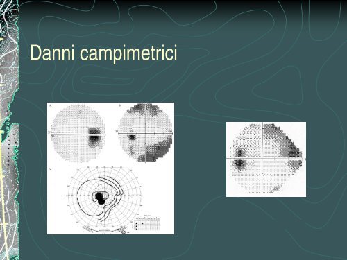 Cosa puÃ² nascondersi dietro un gonfiore papillare - R. Salati