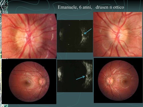 Cosa puÃ² nascondersi dietro un gonfiore papillare - R. Salati