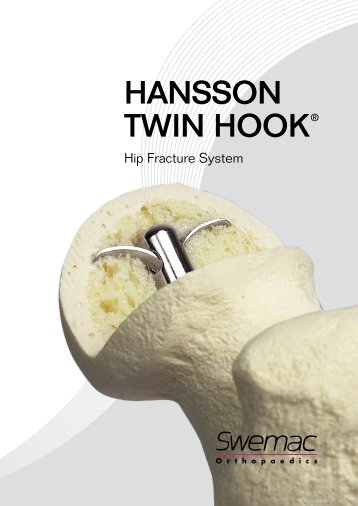 HANSSON TWIN HOOK® - Osteosyntese