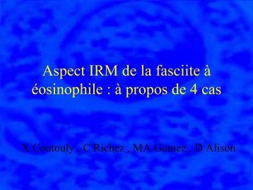 Aspect IRM de la fasciite Ã  Ã©osinophile : Ã  propos de 4 cas