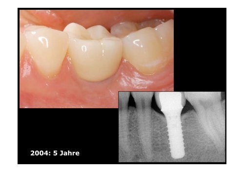 Homepage Implantate - zahnmedizinische kliniken zmk bern ...