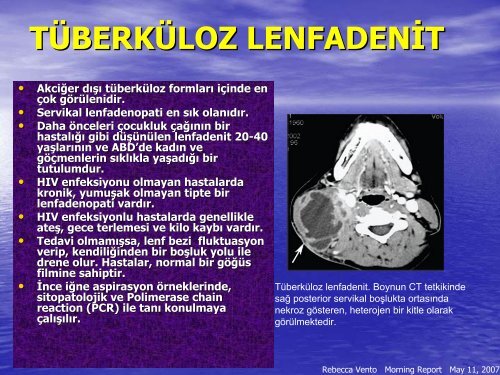 AkciÄer DÄ±ÅÄ± TÃ¼berkÃ¼loz tedavisi