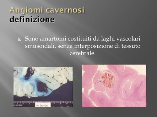 emorragie cerebrali - FacoltÃ  di Medicina e Chirurgia