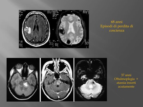 emorragie cerebrali - FacoltÃ  di Medicina e Chirurgia