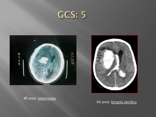 emorragie cerebrali - FacoltÃ  di Medicina e Chirurgia