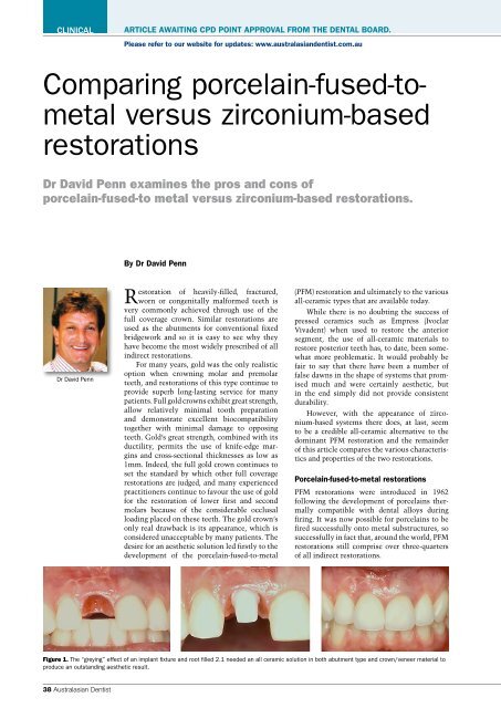 Comparing Porcelain Fused To Metal Versus Zirconium Based