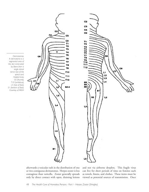 Herpes Zoster (Shingles) - Boston Health Care for the Homeless