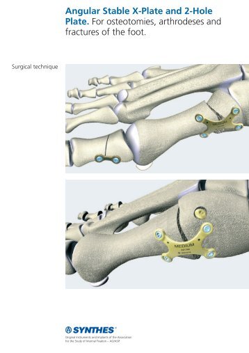 Angular Stable X-Plate and 2-Hole Plate. - Synthes