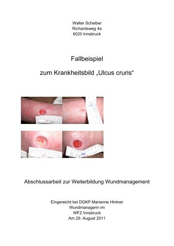 Ulcus cruris - Wundmanagement Tirol