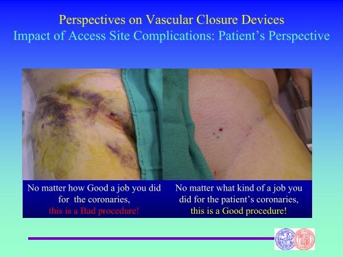 Perspectives on Vascular Closure Device and the Latest Evidence