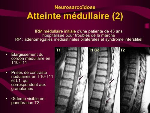 Atteinte musculo-squelettique