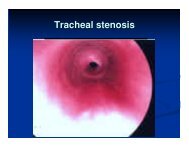 Tracheal stenosis