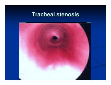 Tracheal stenosis