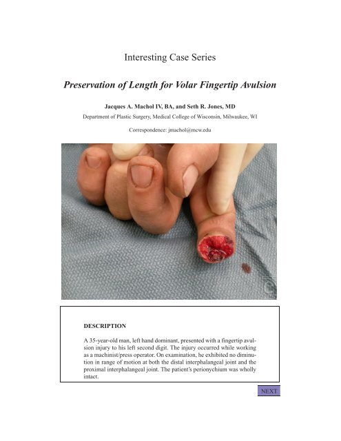 Preservation Of Length For Volar Fingertip Avulsion EPlasty Preservation Of Length For Volar Fingertip Avulsion EPlasty