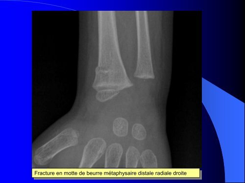 FRACTURES DE L'ENFANT