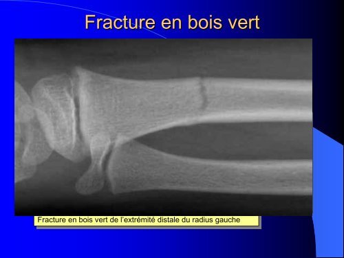 FRACTURES DE L'ENFANT