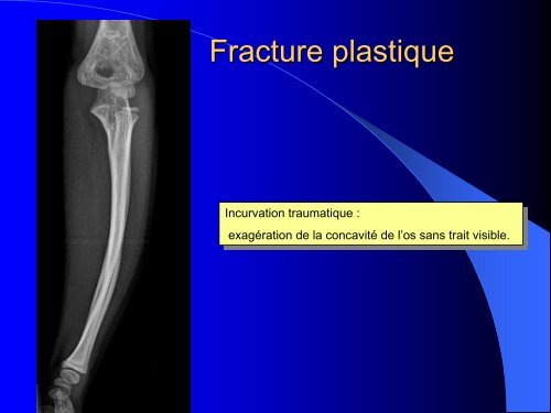 FRACTURES DE L'ENFANT